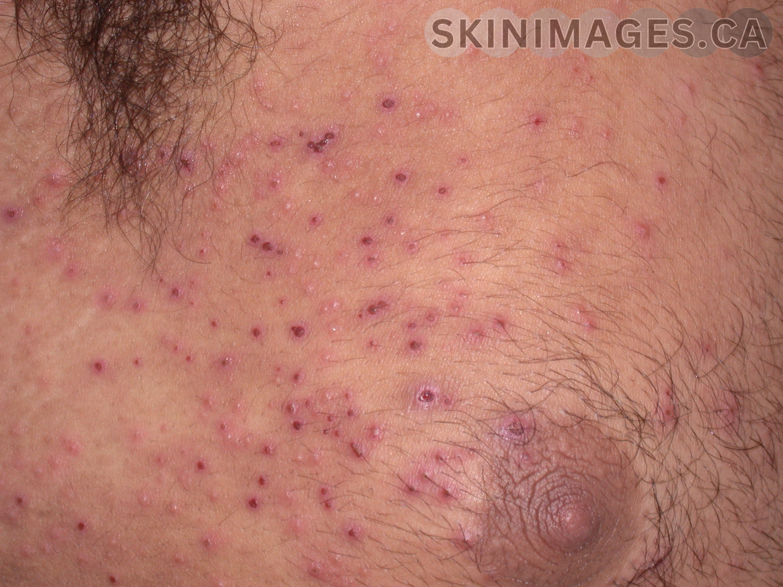 Eczema Herpeticum