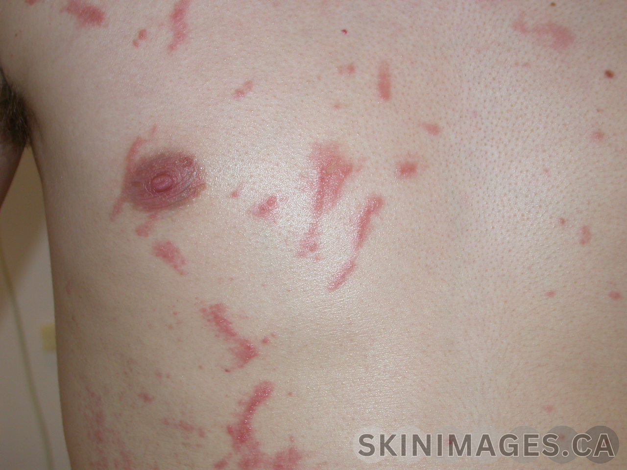 Allergic Contact Dermatitis
