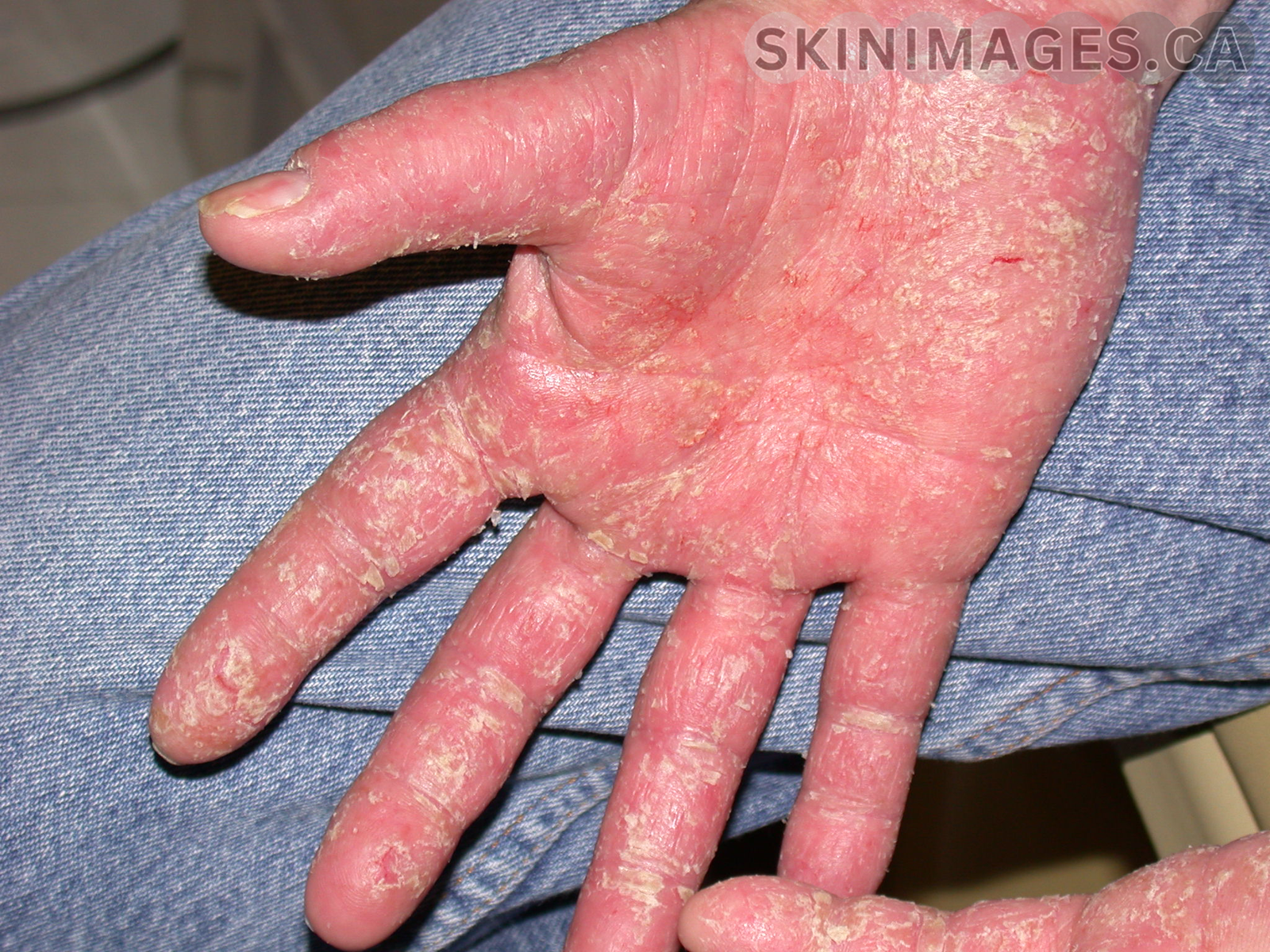 Allergic Contact Dermatitis