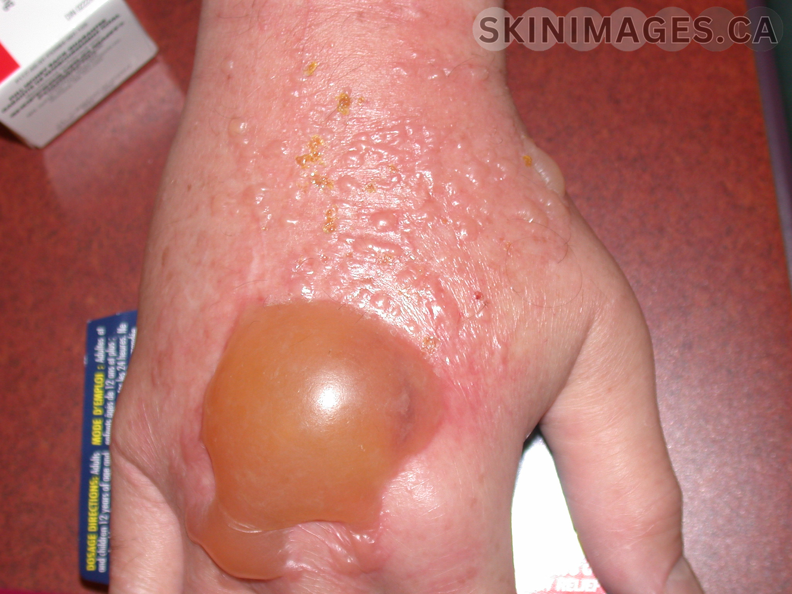 Allergic Contact Dermatitis