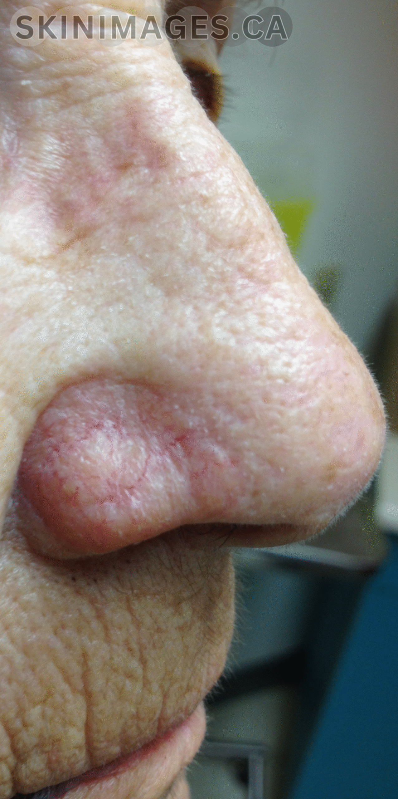 Basal Cell Carcinoma