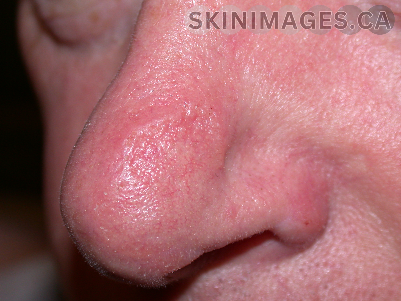 Basal Cell Carcinoma