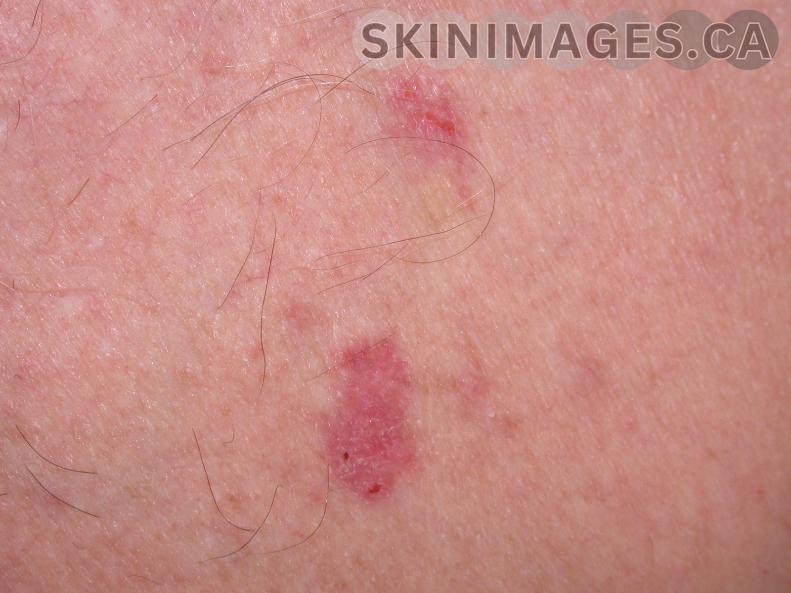 Basal Cell Carcinoma