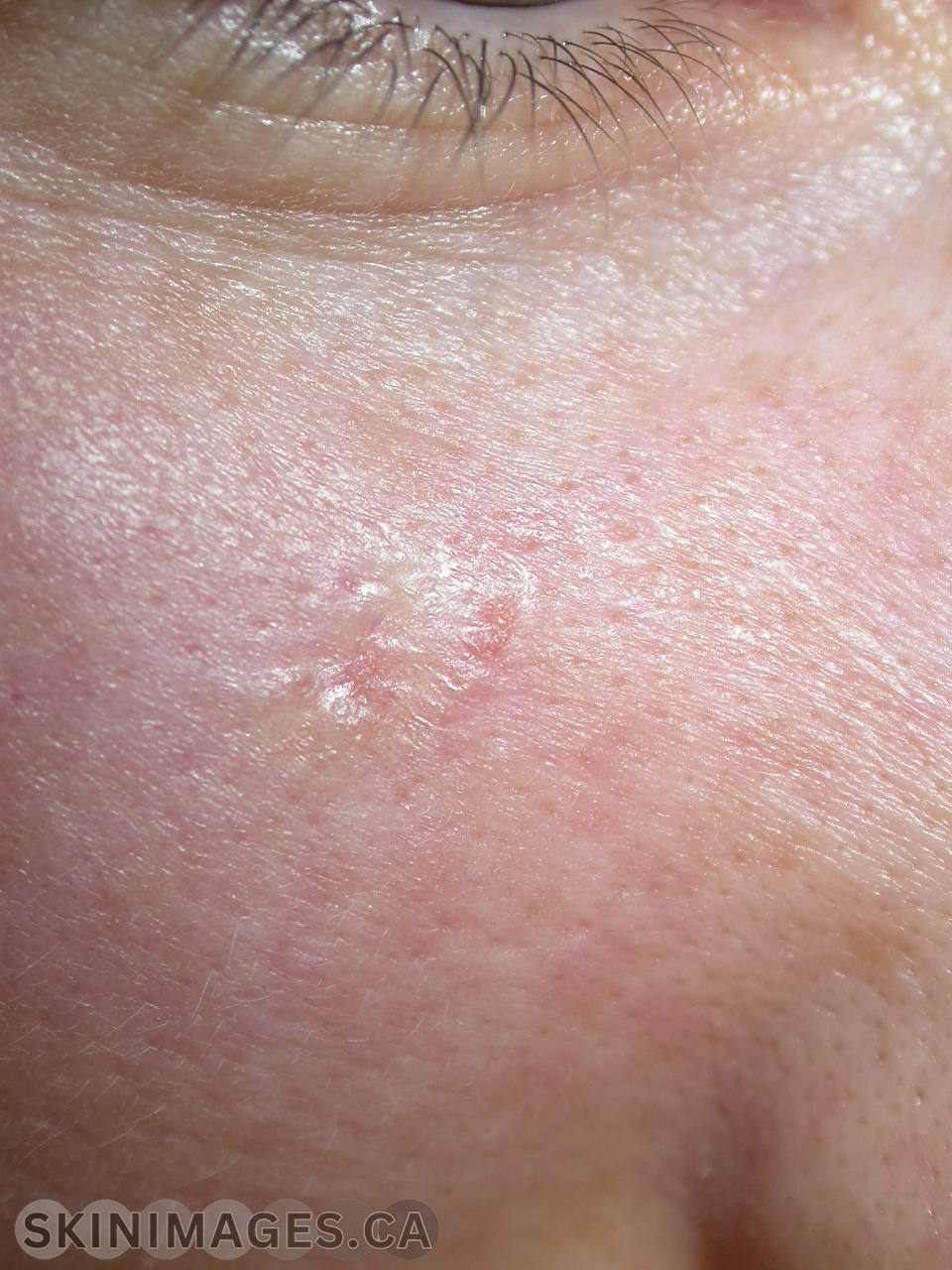 Basal Cell Carcinoma