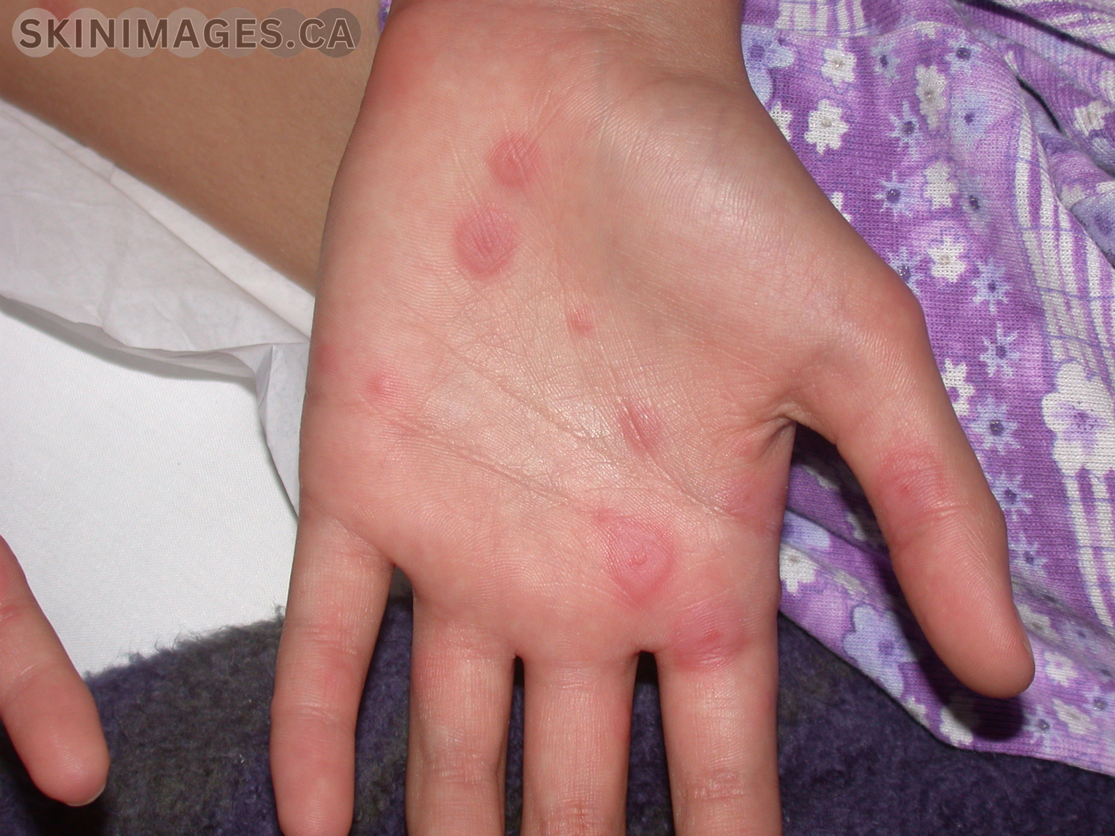 Erythema Multiforme