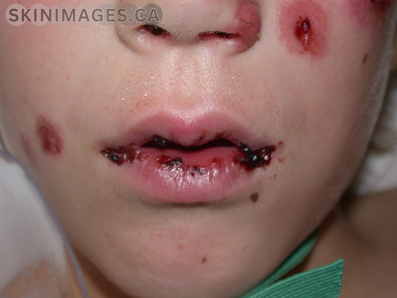Erythema Multiforme