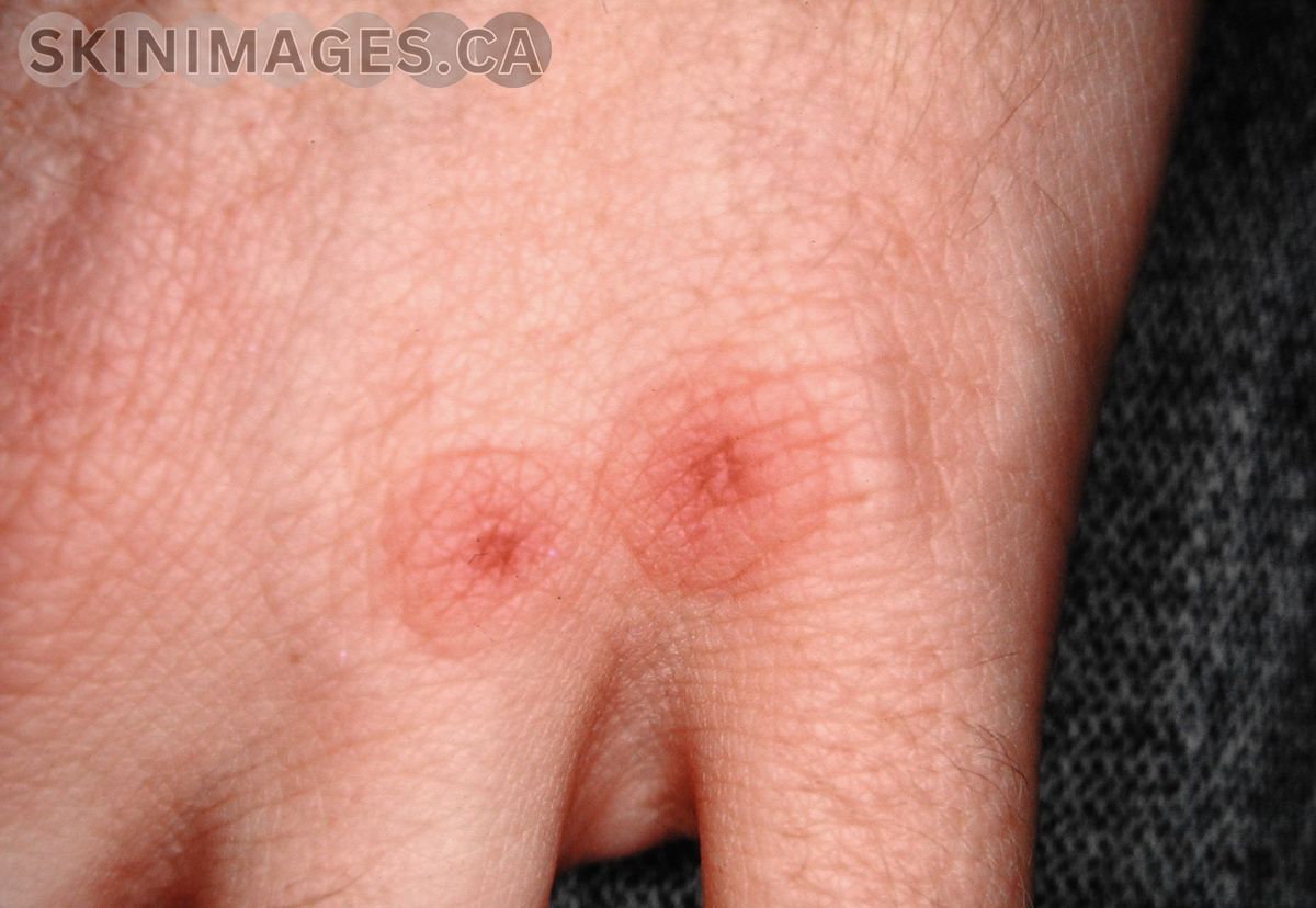 Erythema Multiforme
