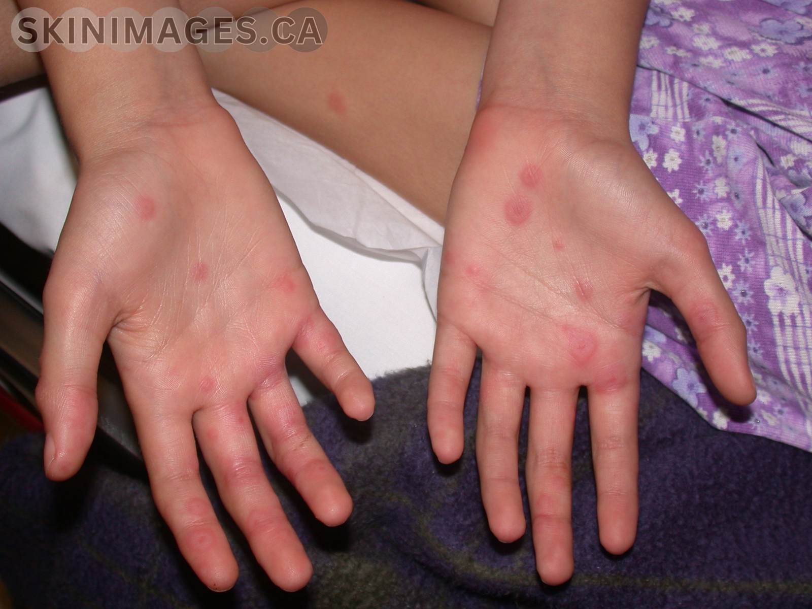 Erythema Multiforme