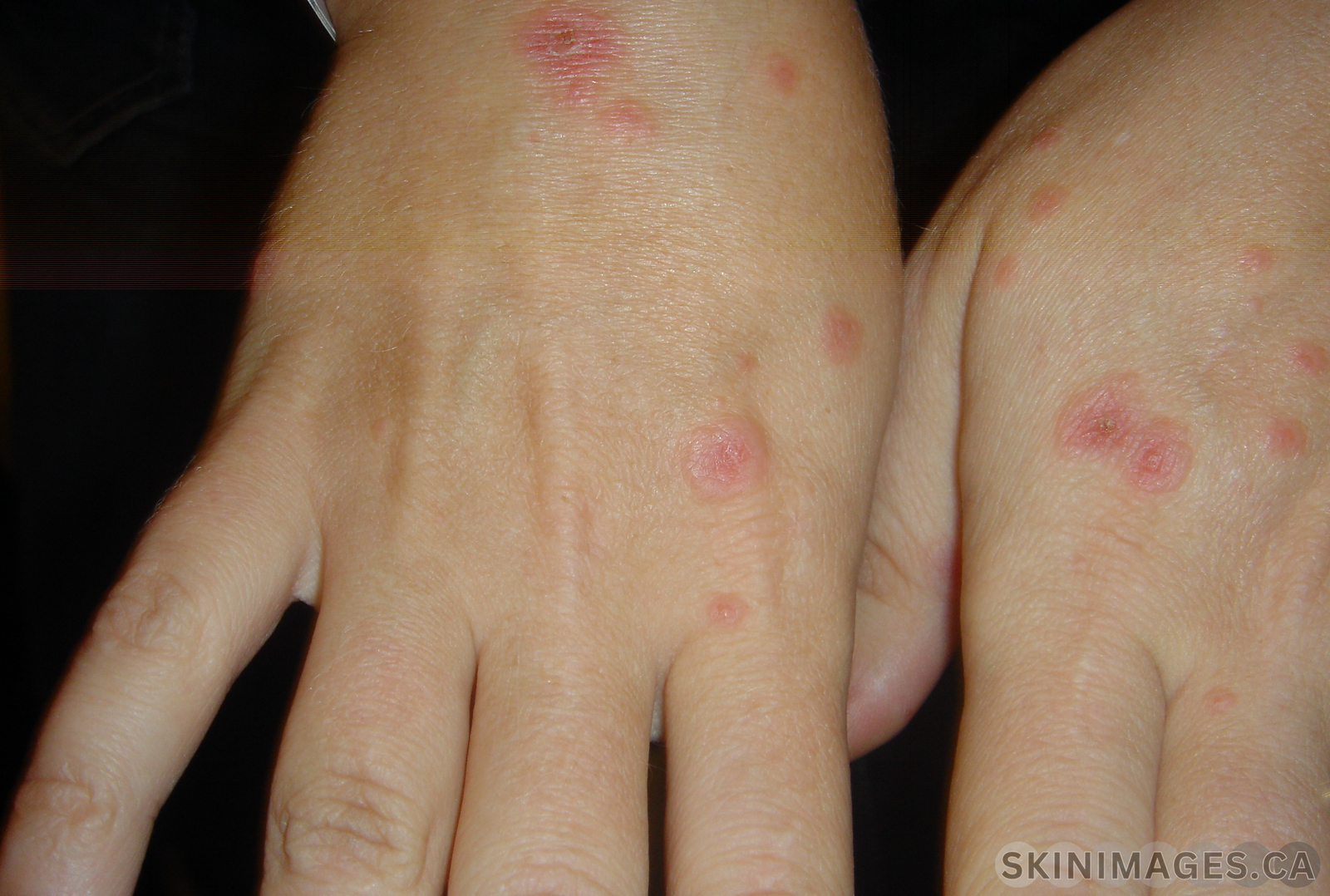 Erythema Multiforme