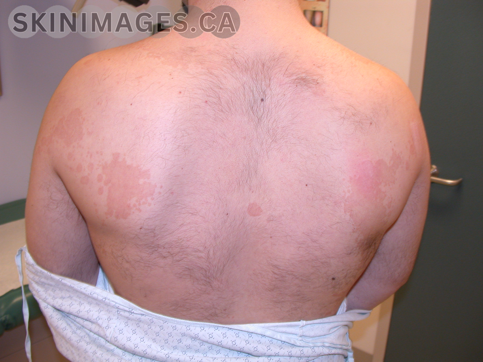 Pityriasis Versicolor
